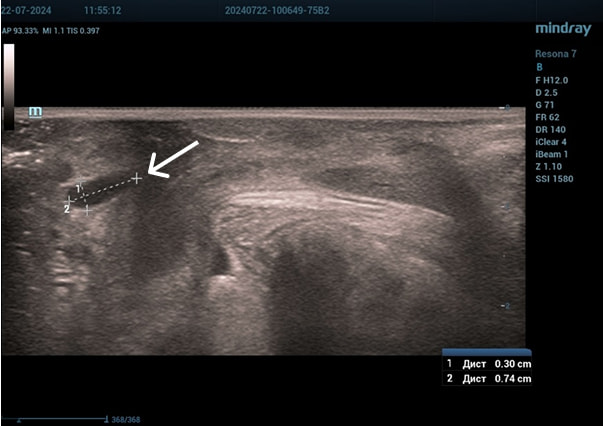 Эхограмма 2