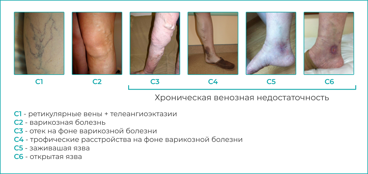Варикозная болезнь и хроническая венозная недостаточность – что необходимо знать пациенту? фото 1